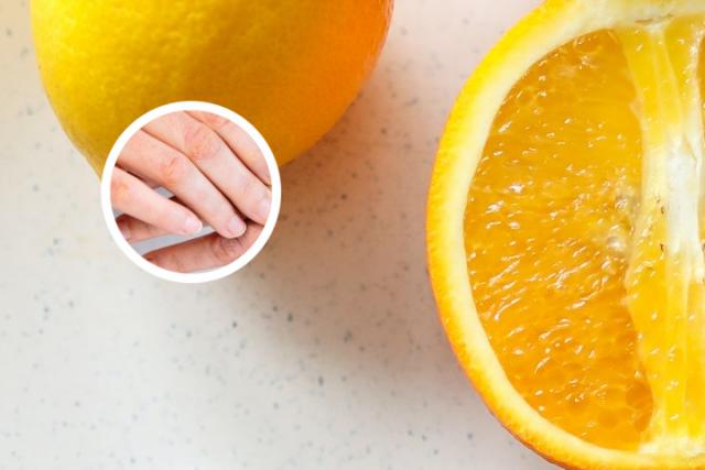 关节型银屑病怎么治