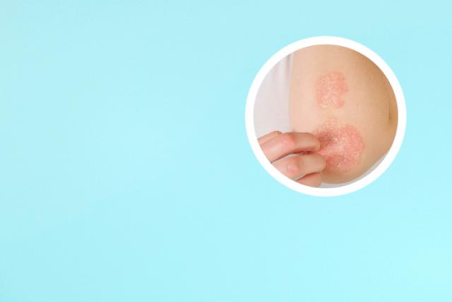 患银屑病的原因有哪些