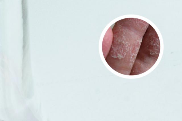 轻微银屑病可以治疗好吗