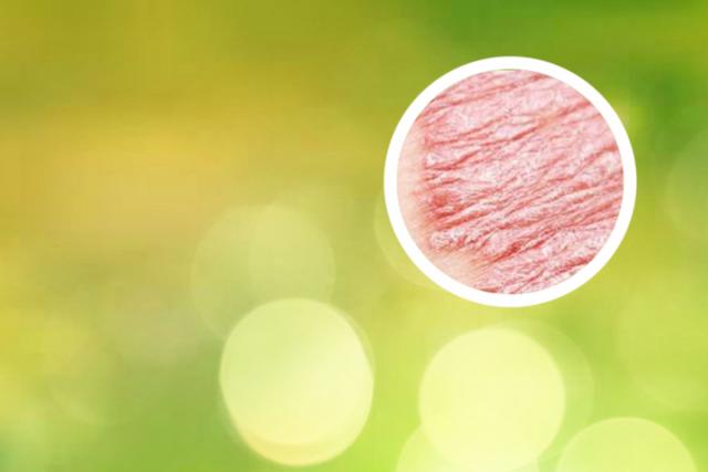 银屑病关节炎看什么科好