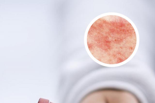 银屑病跟风湿免疫有关吗