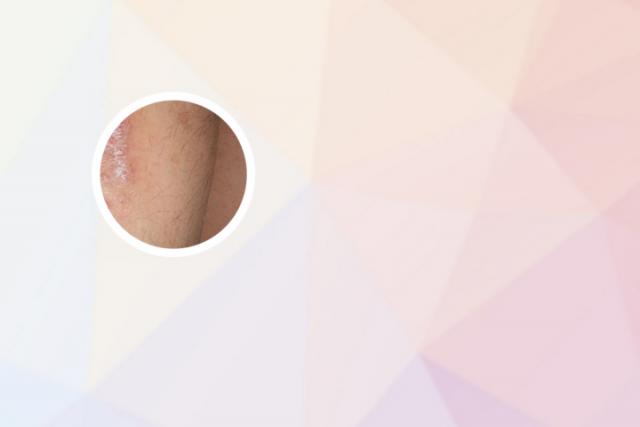 身体干燥掉皮屑怎么办