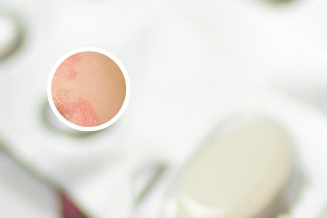 小腿上银屑病为什么难治