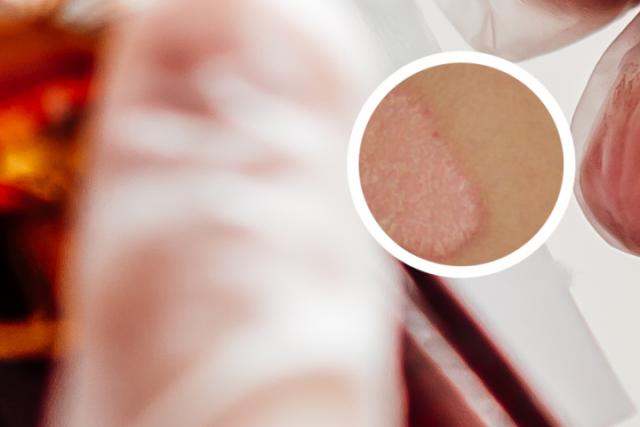 银屑病是什么病有怎样的治疗方法