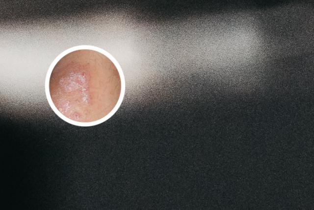 头上初期银屑病能治疗好吗