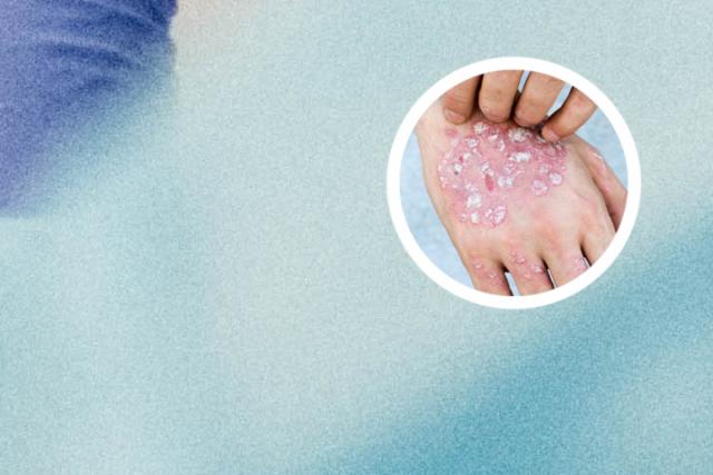 银屑病人不能吃什么水果