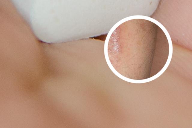 银屑病和类风湿哪个可怕