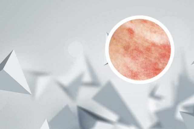 怎样才能治牛皮肤癣