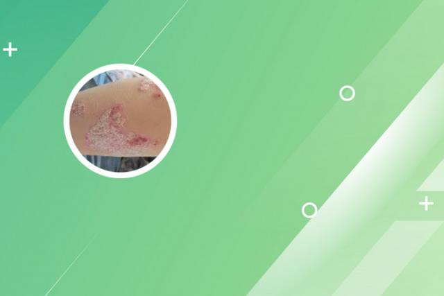 关节炎银屑病的危害