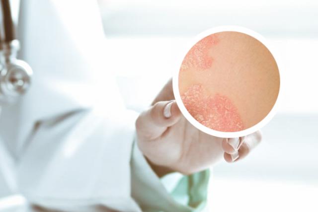 银屑病的克星白醋熬花椒