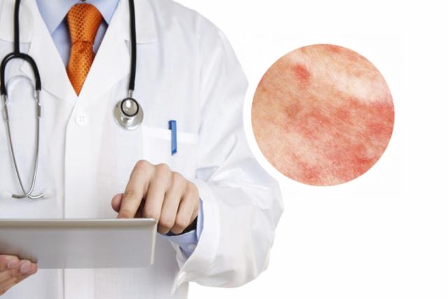 关节病型银屑病的症状