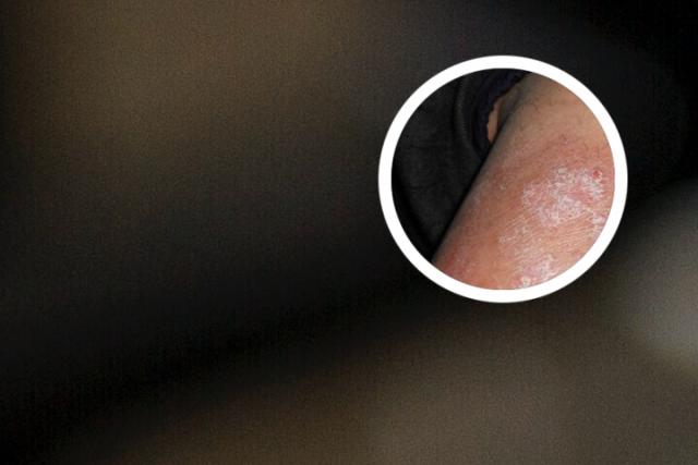 银屑病传染途径