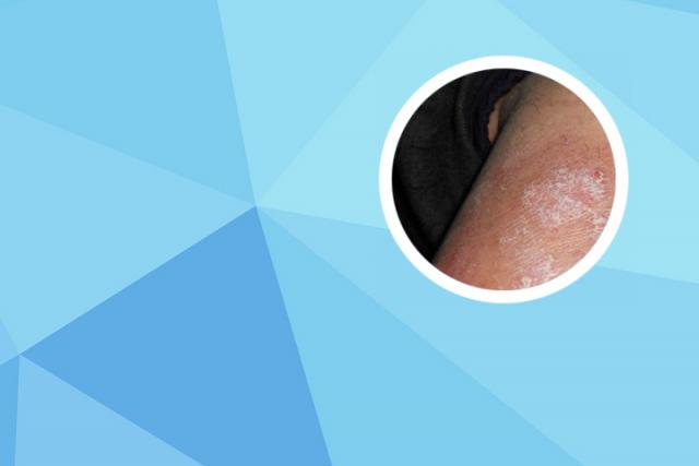 银屑病的克星白醋怎么用