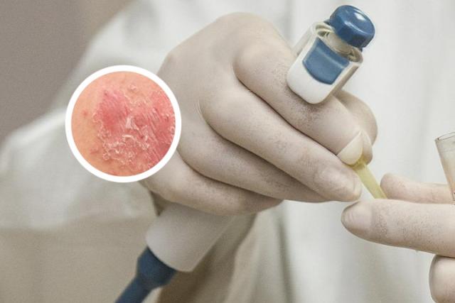 牛皮肤癣怎么治疗