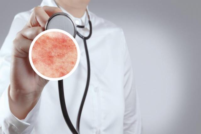 癣的初期症状图片