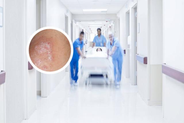 治银屑病快的外用药