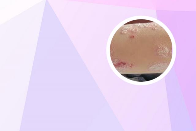 银屑病可以用生理盐水洗吗