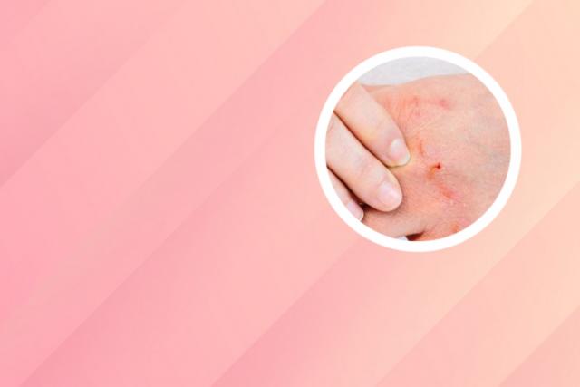 皮肤癣的图片有哪些