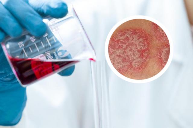 银屑病关节炎新药物