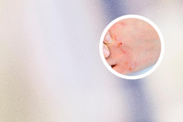 外阴银屑病可以彻底治愈吗