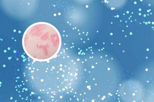 关节型银屑病治疗方法