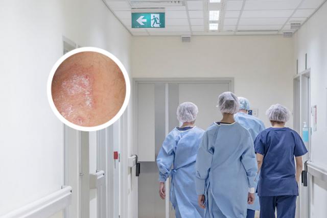 银屑病抹什么软膏