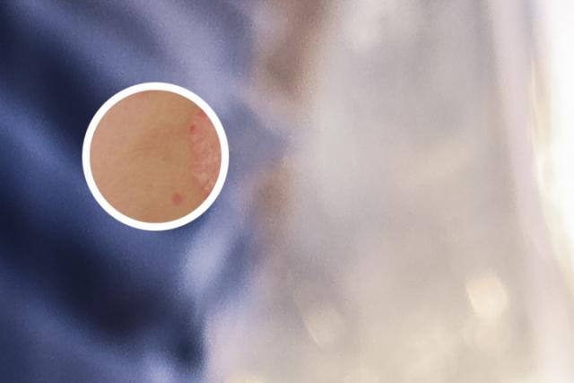 牛皮癣生物制剂管用吗