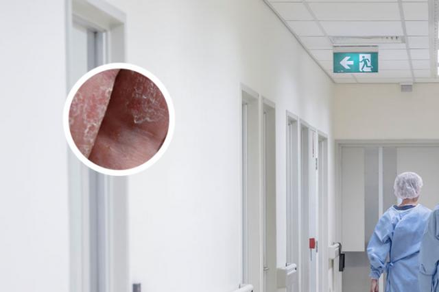 银屑病前期是起红点吗