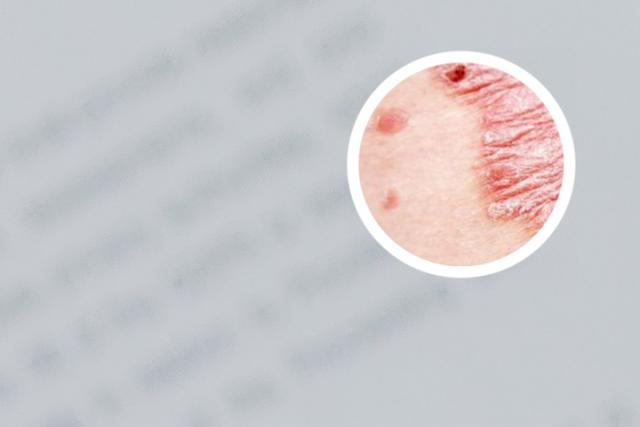 银屑病图片 头部