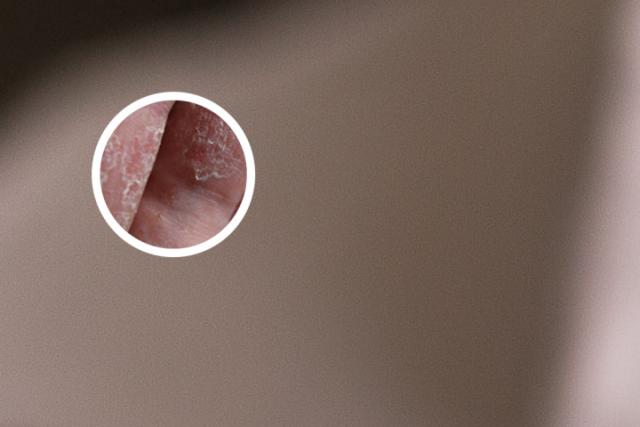 头顶银屑病图片