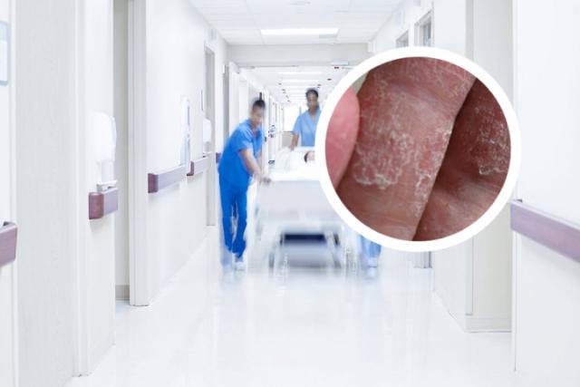 碘伏治好了我的癣