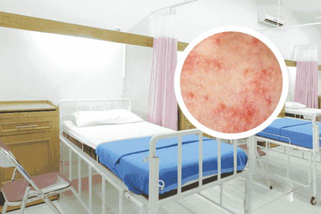 银屑病同房会传染吗