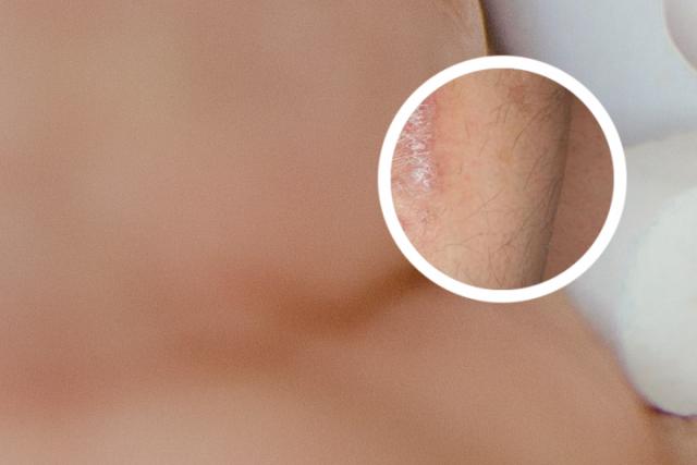 银屑病治疗新进展