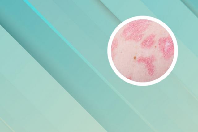 卡泊三醇治好了银屑病