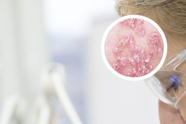 用碘伏去头癣的过程