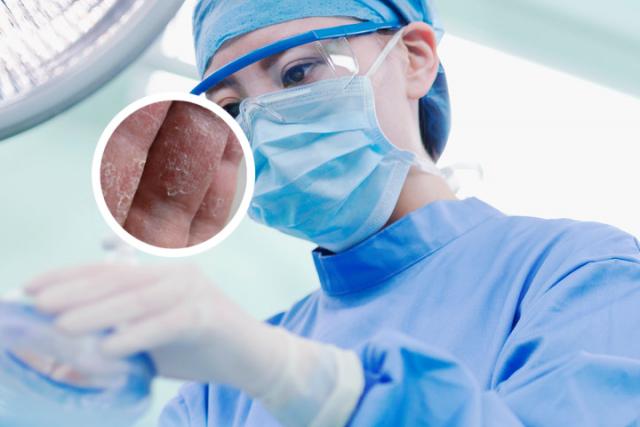 银屑病如果不治疗会怎么样