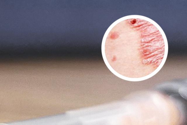 母亲有银屑病会遗传吗