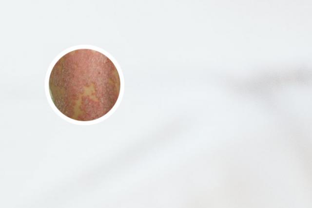 银屑病关节炎和类风湿哪个严重