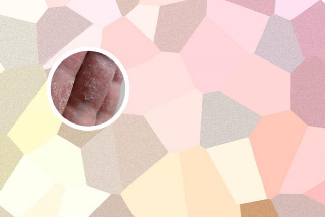 银屑病头屑多用什么洗头