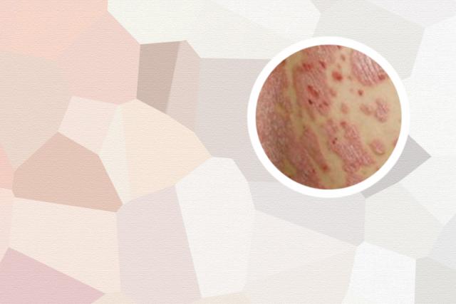 为什么会长皮癣