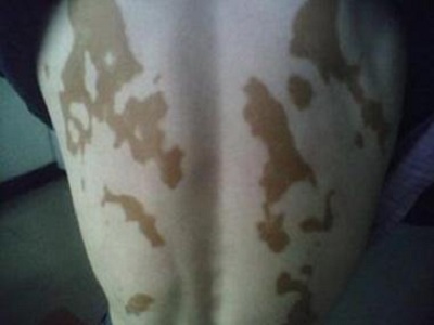 白点癫风最小的症状图