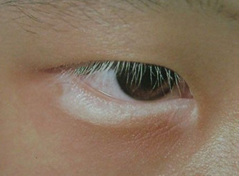 眼部出现白斑
