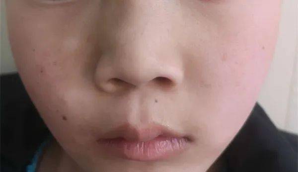 白癫疯早期能治好吗