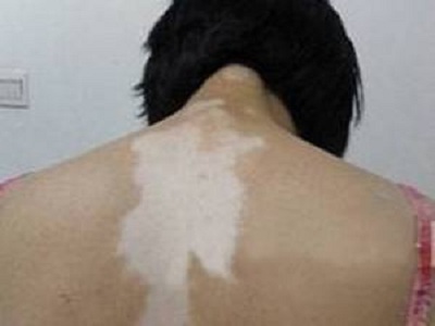 白斑一般能活多少年