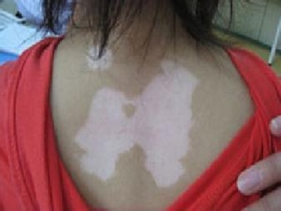 小孩脸上有白斑块怎么回事