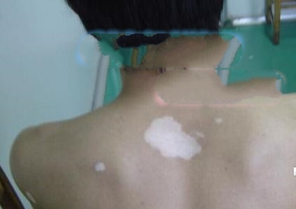 吃什么补充黑色素