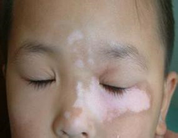小孩子脸边有一小块白
