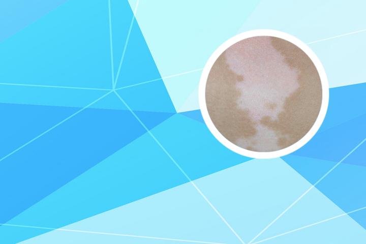 如何确定白斑