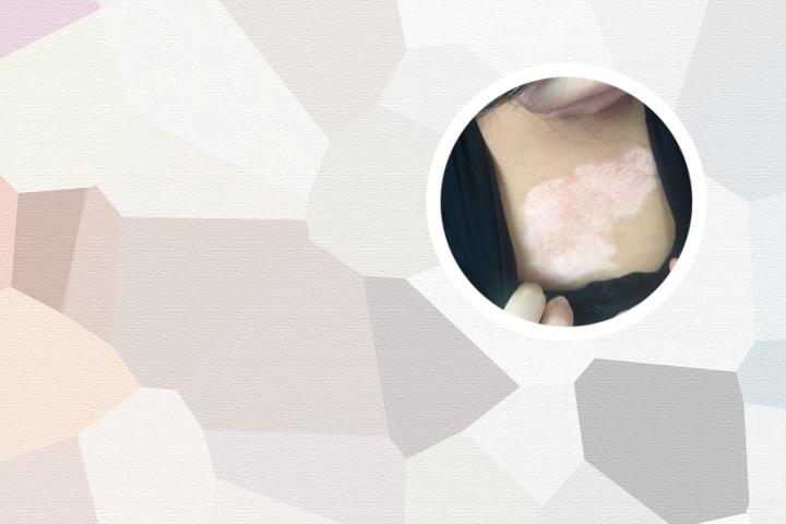 白点癫风能治好吗后天性