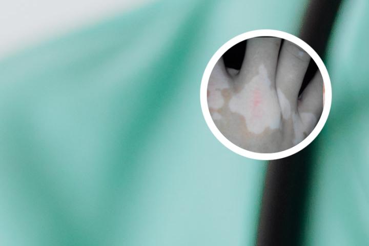 什么药治白斑的效果好